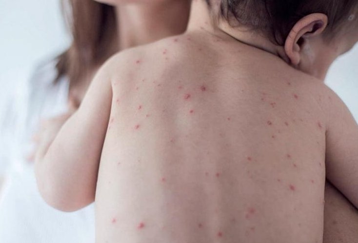 Provincia recomienda controlar los esquemas de vacunación ante los brotes de sarampión